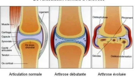 Figure 3 : Évolution d’une articulation atteinte d’arthrose [13]: