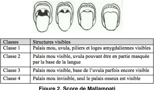 Figure 2. Score de Mallampati 
