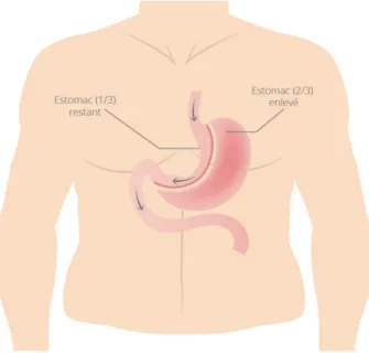 Figure 6 : Sleeve gastrectomie  