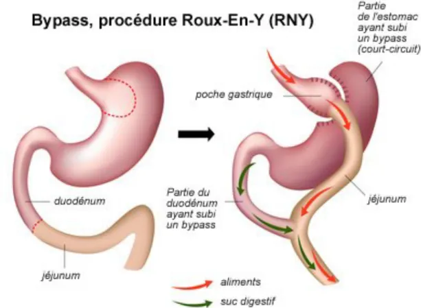 Figure 8 : Avant / Après de la procédure de bypass gastrique en Y 