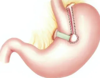 Figure 11 : Gastroplastie verticale calibrée 