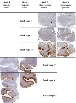 Figure 15 : Immunohistomarquage de coupes de cerveaux de patients atteints par la MA aux  différents stades décrits par le Dr