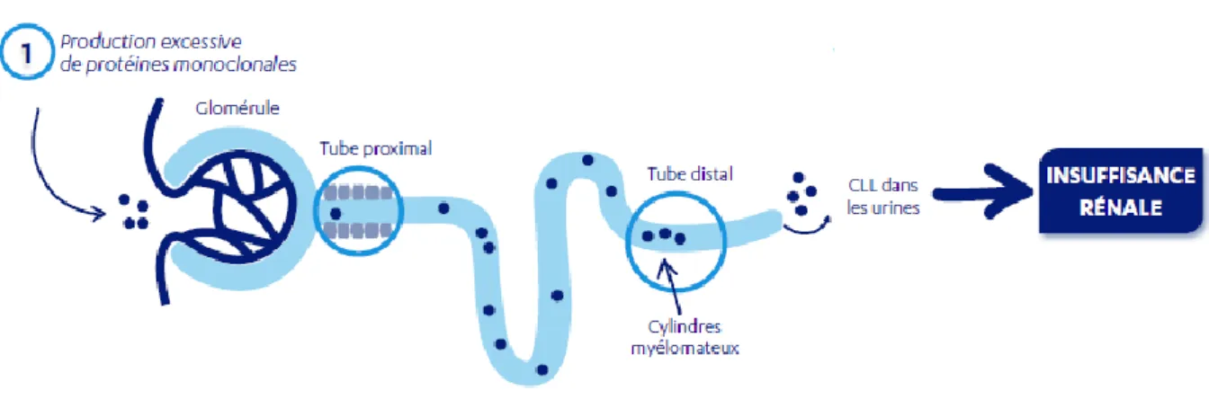 Figure 3 : L’insuffisance rénale lors du myélome multiple (12,19) 