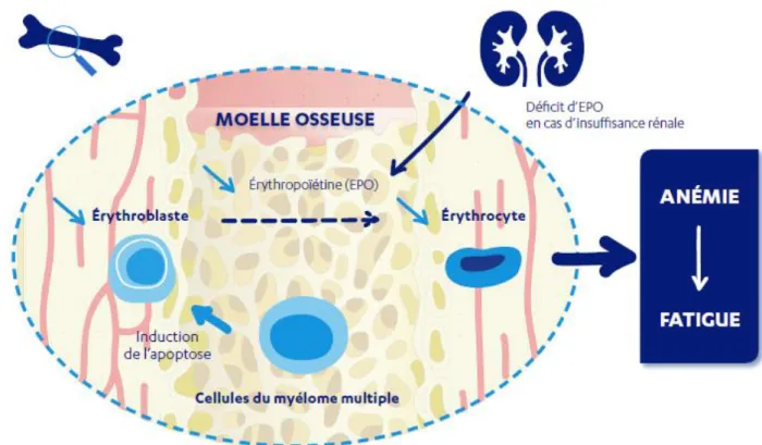 Figure 4 : L’anémie dans le cadre du myélome multiple (11,19)  5.  Les infections 