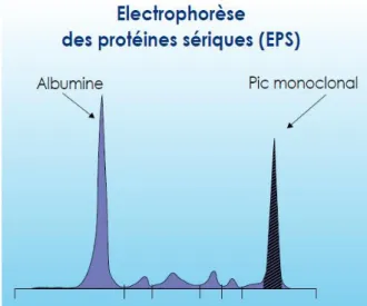 Figure 9 : Présence d’un pic monoclonal au niveau des gammaglobulines détecté par EPS chez  un patient atteint de myélome multiple (34) 