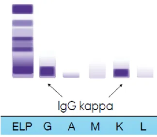 Figure 10 : Identification d’une immunoglobuline G kappa à l’IFE (34)  C.  Myélogramme 
