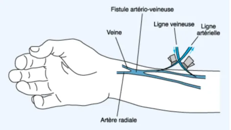 Figure n°2 : Représentation d'une fistule artério-veineuse 