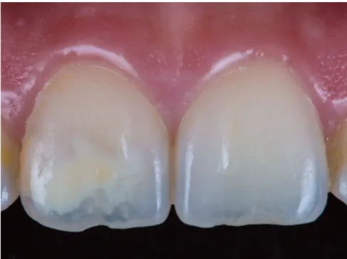 Figure 9 : photographie de la complexité de la couleur d’une dent 