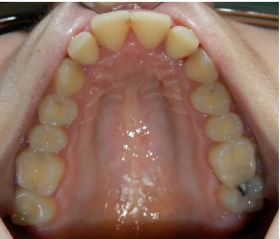 Figure  8:  vue  intrabuccale  centrée  sur  les  faces  occlusales  de  l'arcade  mandibulaire  (document personnel) 