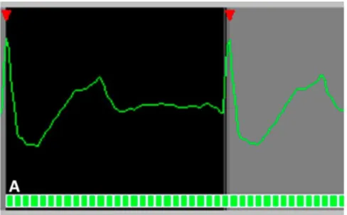 Figure 1 :  La synchronisation rétrospective permet d’enregistrer toutes les phases du cycle