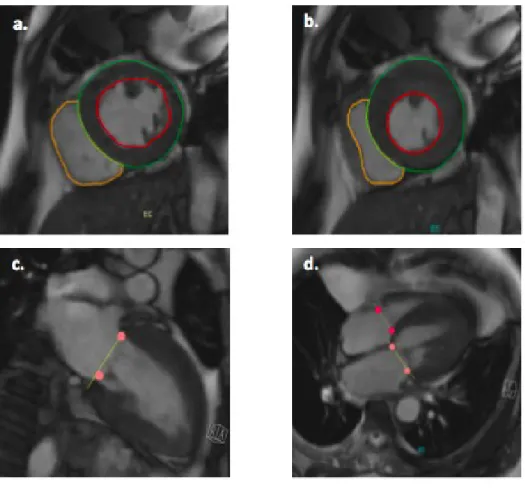 Figure 4 :      Les contours rouges délimitent par convention l’endocarde du ventricule gauche, les contours verts ceux de l’épicarde du ventricule gauche et les contours jaunes ceux de l’endocarde du ventricule droit
