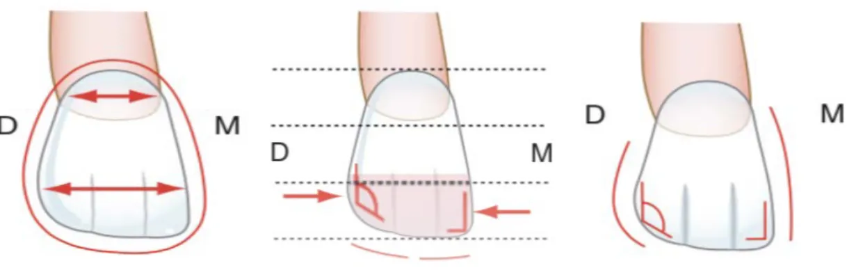Figure 3 : Vues de la face mésiale d’une incisive larérale maxillaire  [ 43 ]