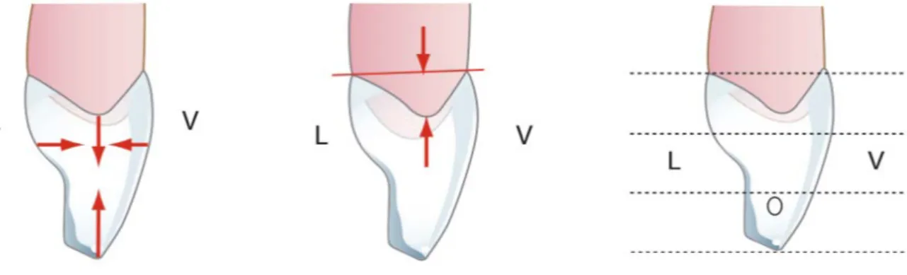 Figure 4 : Vues de la face distale de l’incisive latérale maxillaire  [ 43 ]