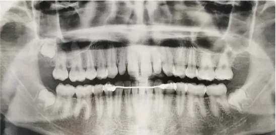 Figure 13: Incisives latérales maxillaires riziformes bilatérales et agénésie de la  troisième molaire maxillaire gauche 28 (Sarah MOUAOUED) 