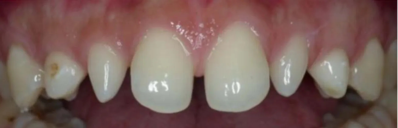 Figure 14 : Sourire avec présence d’incisives latérales maxillaires riziformes  bilatérales et de diastèmes  [ 1 ]