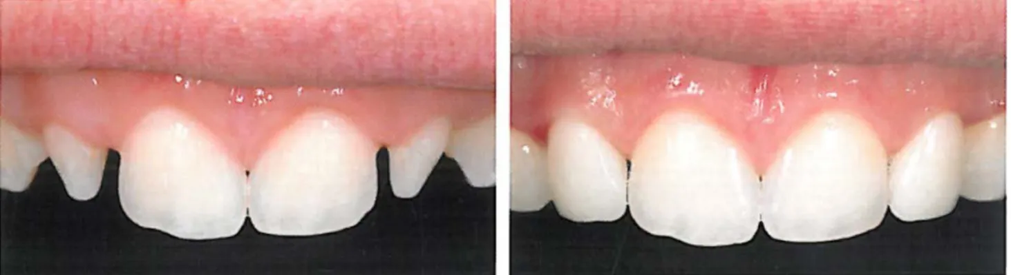 Figure 15 : Sourire avant (à gauche) / après (à droite) l’apposition des mock-up chez  une patiente de 16 ans  [ 37 ]