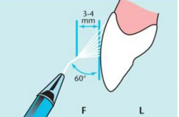 Figure 5 : Angulation correcte du jet d’aéro-polissage pour les dents antérieures. [10] 