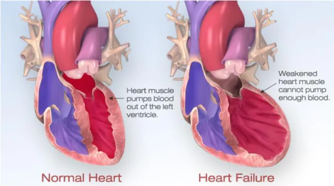 Figure 4 : Influence de l’HTA sur l’anatomie cardiaque 19