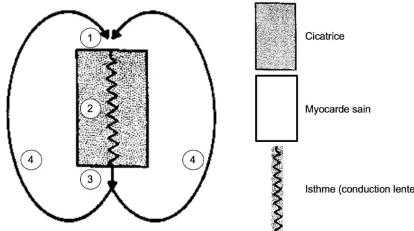Figure  1 :  Schématisation  d’un  circuit  de  réentrée  sur  une  cardiopathie 