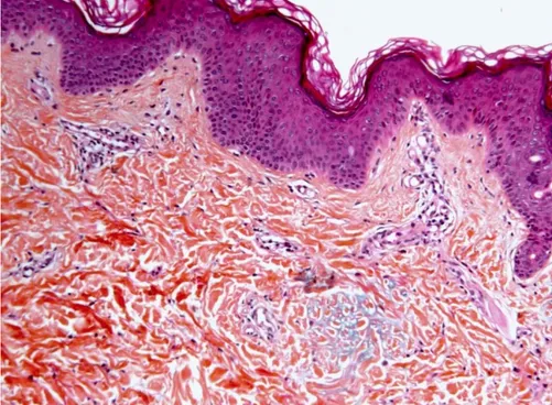 Figure 3 : Infiltrat lymphocytaire péri vasculaire avec dépôts de mucine dans le derme  superficiel
