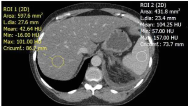 Figure 13 : Observation par tomodensitométrie d'un  foie stéatosique. Le foie a une atténuation de 42,64  HU (Hounsfield units) et la rate a une atténuation de  104,25 HU