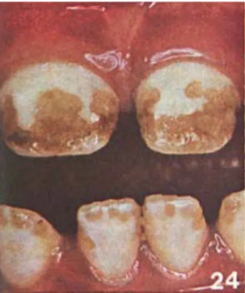 Figure 10 : Photographie d’un score 8 de la classification de Thylstrup et  Fejerskov (57)
