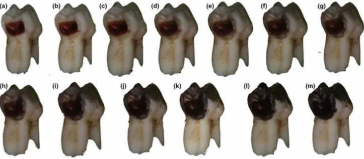 Figure 12 : Evolution de la coloration noire durant les 12 heures après  l’application du fluorure diamine d’argent à 38% : (a) avant application, (b)  immédiatement après l’application, (c) 5 minutes après, (d) 10 minutes après, (e) 30 