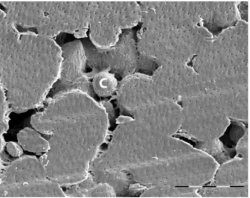 Figure   11     : Image de microscopie électronique à balayage mettant en évidence une dentine pathologique avec des défauts de fusion des