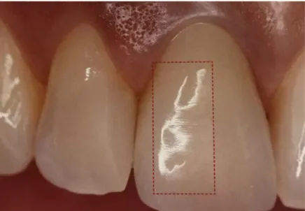 Figure 13: Anomalie de texture repérée par une position à 9 heures  du praticien [51] 