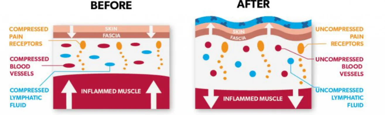 Figure 1.3. Hypothetical effects of kinesiotaping underneath the skin (lifting effects)