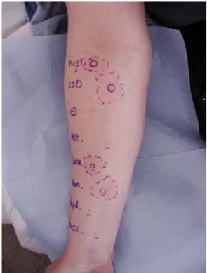 Figure n°10 : Résultat d’un Prick-test : Témoins codéine et histamine positifs (46) 