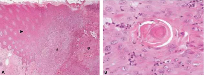 Figure 7 : Histologie d’un carcinome épidermoïde infiltrant palpébral d’un cheval mâle de 15 ans