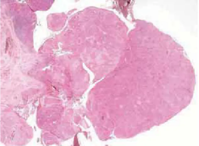 Figure 10 : Histologie d’un carcinome épidermoïde de la membrane nictitante d’un hongre de 10 ans