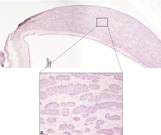 Figure 13 : Histologie d’un carcinome épidermoïde cornéen infiltrant stromal, d’un cheval mâle de 21 ans A : La tumeur présente à la fois un développement exophytique sur la conjonctive limbique et une infiltration étendueentre les lamelles du stroma corné