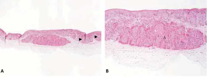 Figure 14 : Histologie d’un carcinome in situ cornéen d’un cheval mâle de 13 ans