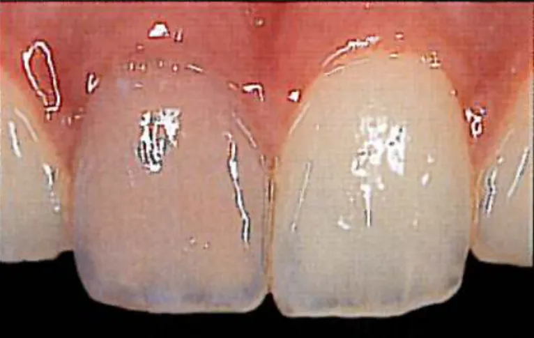 Figure 22 : Photo d’une incisive centrale en état d’hémorragie pulpaire après un  choc(P.MAGNE [63]) 