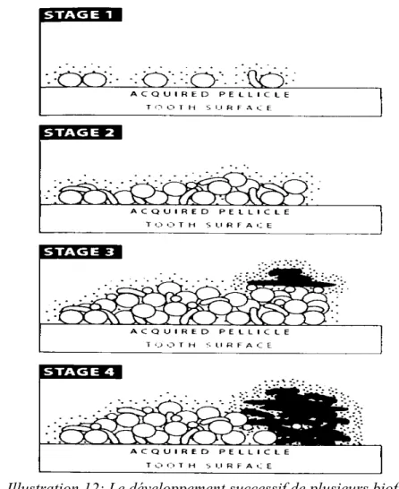 Illustration 12: Le développement successif de plusieurs biofilms spécifiques sur la surface d'émail (50).