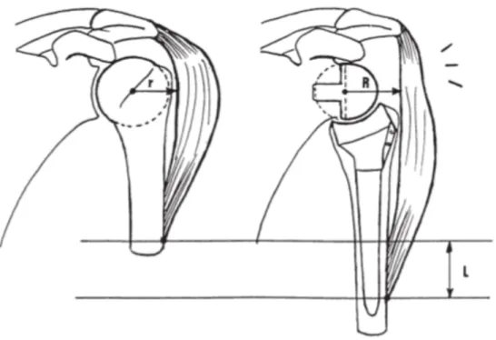 Figure 2 :  La médialisation du centre de rotation permet d’augmenter le bras de levier du  deltoïde  (R)