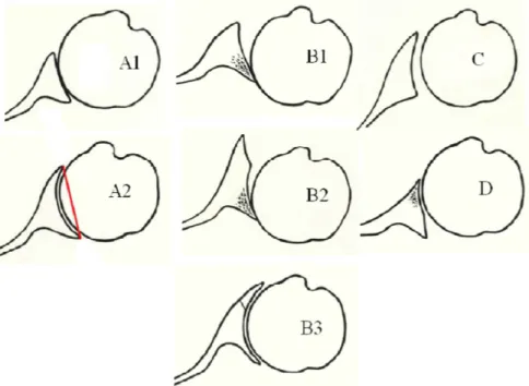 Figure 9 : Morphologie de la glène selon la classification de Walch 