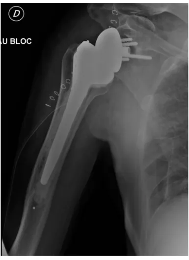 Figure 13 : Radiographie d’épaule de face en rotation neutre post-opératoire immédiate  après arthroplastie d’épaule inversée