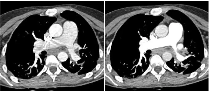 Figure 1: Single-energy chest CT angiographic examination obtained with a 35  yr-old female with a BMI of 25.2 kg/m2 (161 cm; 60 kg) referred for suspicion of  acute PE in the context of acute chest pain 