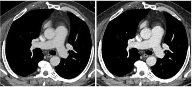 Figure 4: Dual-energy chest CT angiographic examination obtained with a 48  yr-old male with a BMI of 28.6 kg/m2 (170 cm; 83 kg) referred for suspicion of  acute PE in the context of right lower limb surgery 