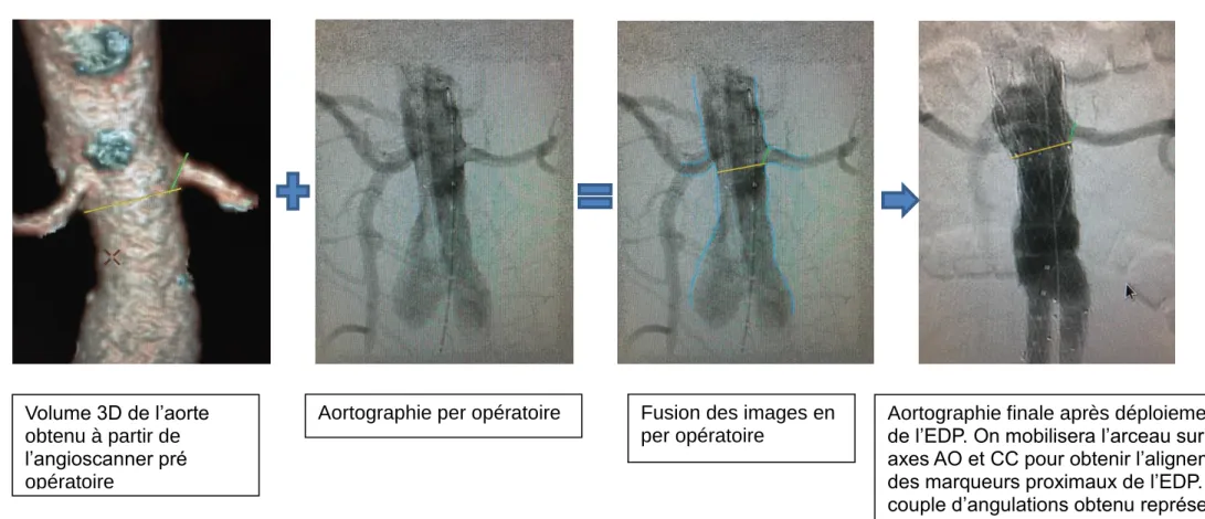 Figure 2 : Fusion des images : la reconstruction 3D de l’aorte à partir de l’angioscanner pré opératoire est superposée à  l’aortographie en per opératoire (a)