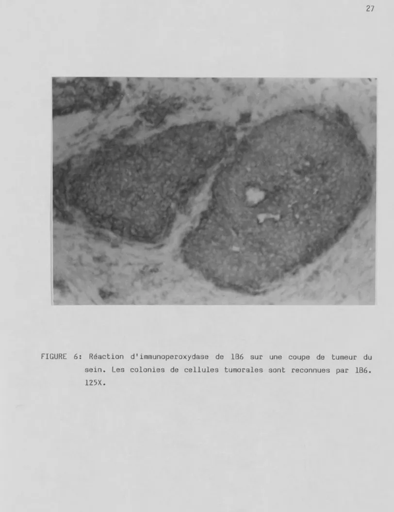FIGURE 6: Réaction d1immunoperoxydase de 1B6 sur une coupe de tumeur du  sein. Les colonies de cellules tumorales sont reconnues par 1B6