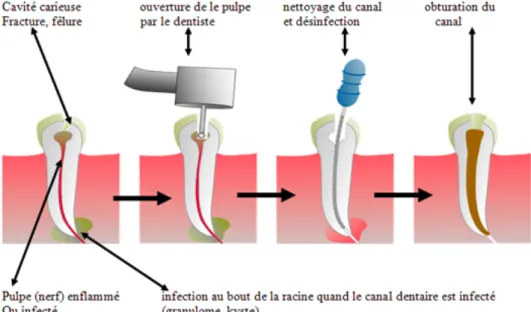 Figure 1 : Étapes du traitement endodontique [55] 