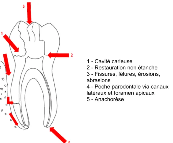 Figure 2 : Voies de contamination bactérienne de l'endodonte [43] 
