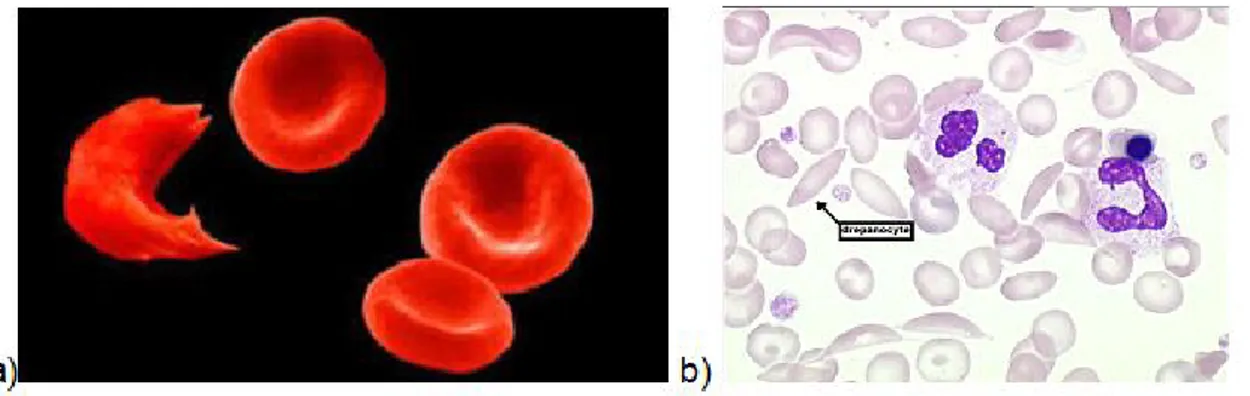 Figure 1 : Photographie a) d’une hématie falciformée et de 3 hématies de forme  normale (2) ; b) d’un frottis sanguin coloré au May Grunwald Giemsa avec des 