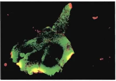 Figure 1.6 : Visualisation de cellules du cancer du sein humain MDA-MB-435 par  fluorescence GFP montrant la surexpression de la galectine-3 (vert) et de la galectine-8 
