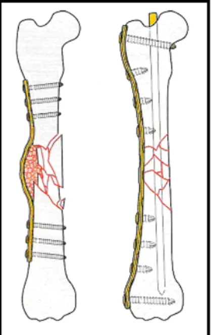 Figure 8 :  Fracture comminutive stabilisée par une plaque en soutien seule ou associée                                 à un clou centro-médullaire (46) 