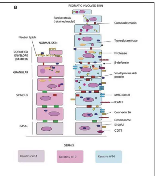 Figure 16 : Différences majeures entre l'épiderme normal et psoriasique en ce qui  concerne la structure et l'expression des gènes [11] 